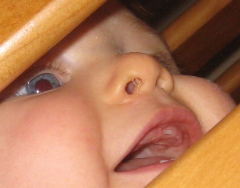 Teeth erupting up top