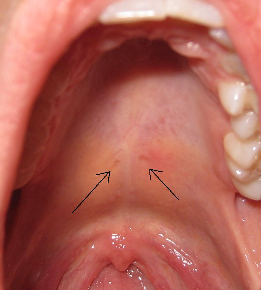 Hole In Roof Of Mouth 121